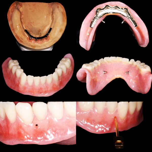 Collage showing dental implants and dentures with metal framework and attachment points.