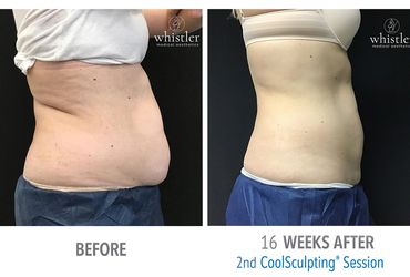 Before and After Coolsculpting Patient 