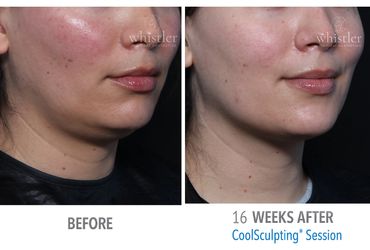 Before and After Coolsculpting Patient 
