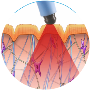 During Exilis Treatment