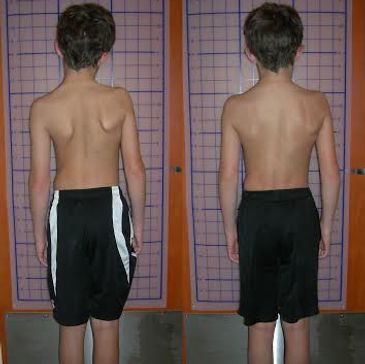 Before and After Pictures, Schroth Method, Improve Posture, Intensive Training, Symmetrical Posture