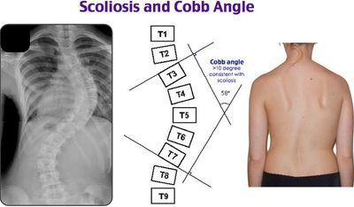 Adolescent Idiopathic Scoliosis, Cobb Angle, Schroth Method, Scoliosis Exercises, Adult Scoliosis, A