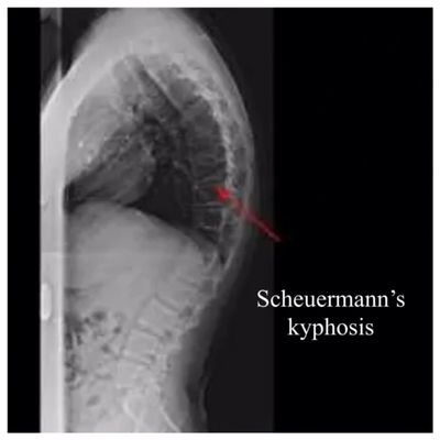 hyperkyphosis, Scheuermann's kyphosis, pain, schroth method, exercises, posture