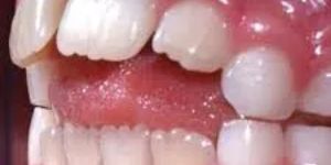 Tongue Thrust Therapy