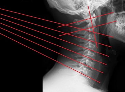 Normal cervical alignment rarely observed in a chiropractic office