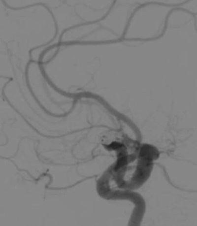 Angiography