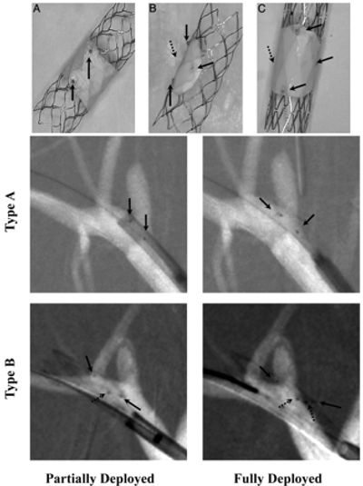 Devices to treat intracranial aneurysm