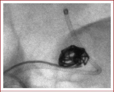 Microangiographic fluoroscope shows individual coils and accurate catheter positioning