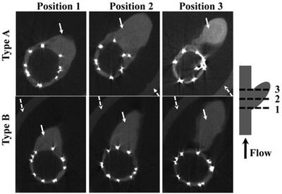 Micro-CT sections of explanted aneurysms treated with 2 types of Asymmetric Stent
