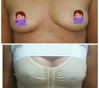 Aumento mamario
Implante de mamas
Prótesis de mamas
cirugia plastica nicaragua
cirujano plastico
