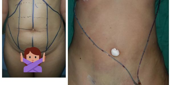 Abdominoplastia
liposuccion abdominal
minia abdominoplastia
cirugia plastica
cirujano plastico 
