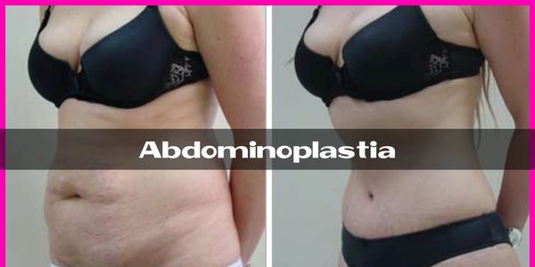 Abdominoplastia
liposuccion abdominal
minia abdominoplastia
cirugia plastica
cirujano plastico 