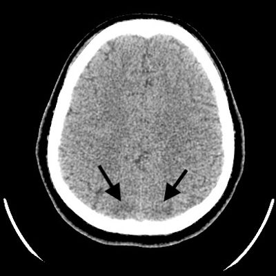 Figure 1: Brain CT scan showed hypodense area at posterior parts of the bilateral occipital lobes