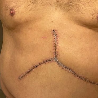 Ben's surgical scar 15 days after his first transplant surgery in 2021.