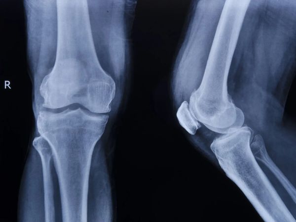 X-ray of a knee