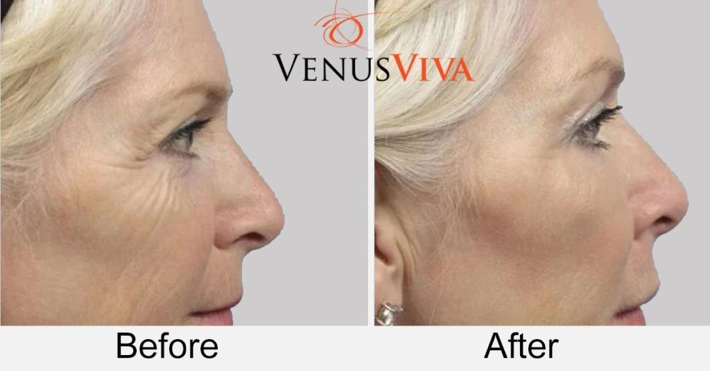 Laser Skin Rejuvenation with Venus Viva™ Before and After