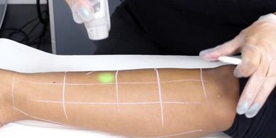laser hair removal being performed on a lower leg