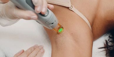 laser hair removal being performed under the armpits