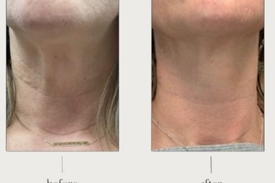 results of fibroblast on neck