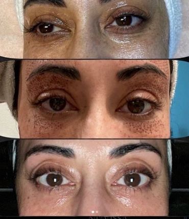 plasma current fibroblast skin rejuvination before and after