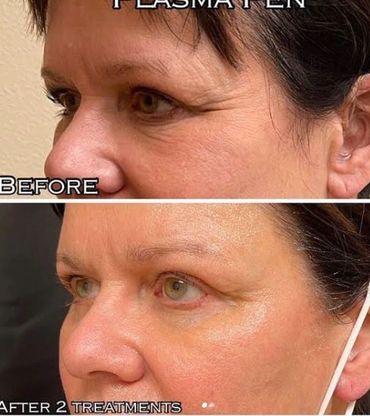 plasma current fibroblast skin rejuvination