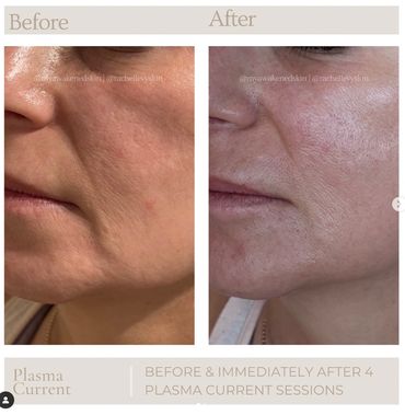 Plasma current fibroblast skin rejuvination in the jowl area