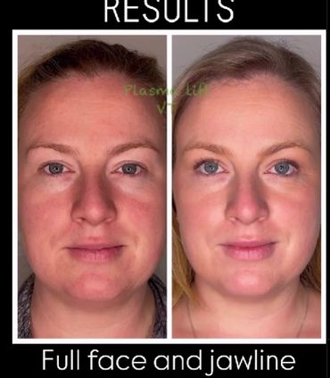 results of a full face and jawline of the fibroblast treatment,