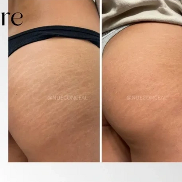 Inkless stretch mark revision on a butt