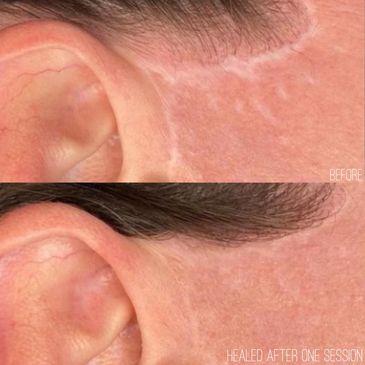 Scar camouflage on a facelift scar in front of the ear