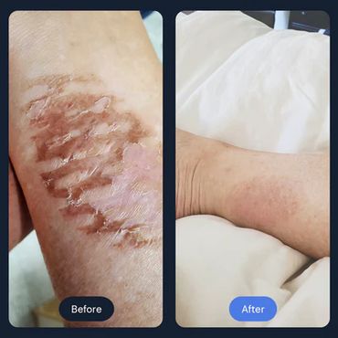 Localized Cryotherapy for scar, arthritis, acne and other skin conditions