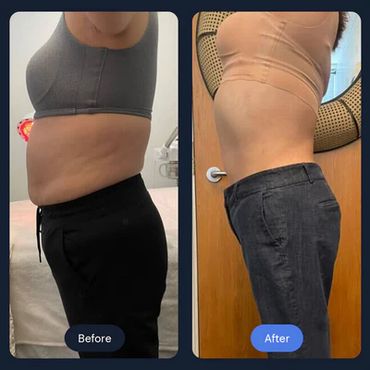 Cryoslimming at CryoStrong Toronto in Markham how it works before and after.