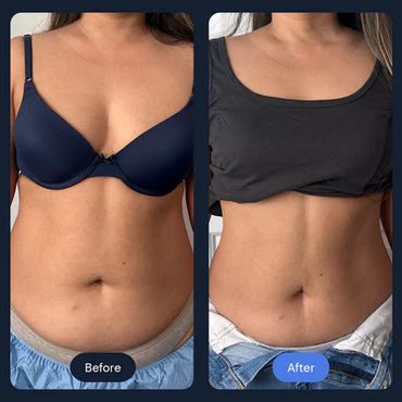 Cryoslimming at CryoStrong Toronto in Markham how it works before and after.