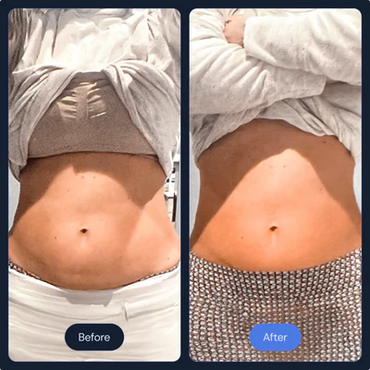 Cryoslimming at CryoStrong Toronto in Markham how it works before and after.