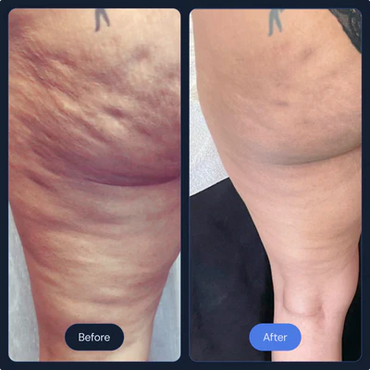 Cryoslimming at CryoStrong Toronto in Markham how it works before and after.