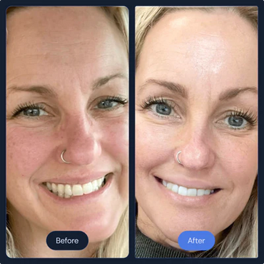 Before and After Frotox/Facials