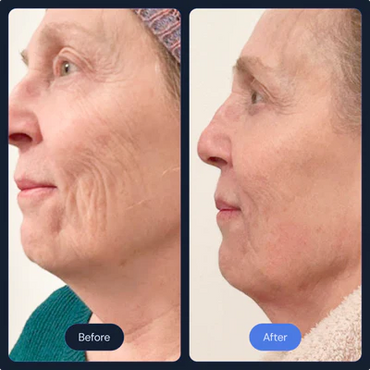 Before and After Frotox/Facials