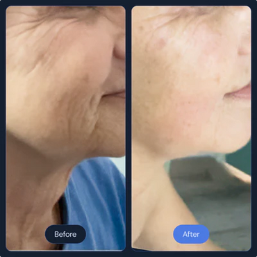 Before and After Frotox/Facials