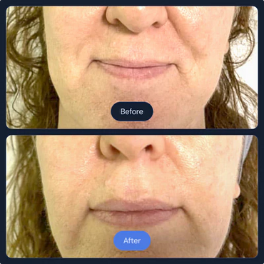 Before and After Frotox/Facials