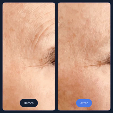 Before and After Frotox/Facials