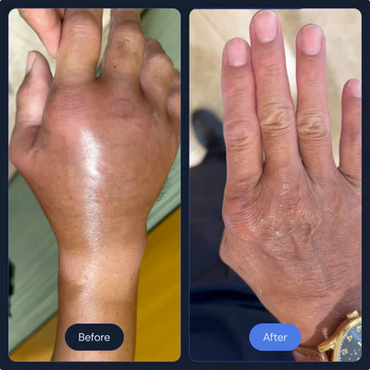 Localized Cryotherapy for scar, arthritis, acne and other skin conditions