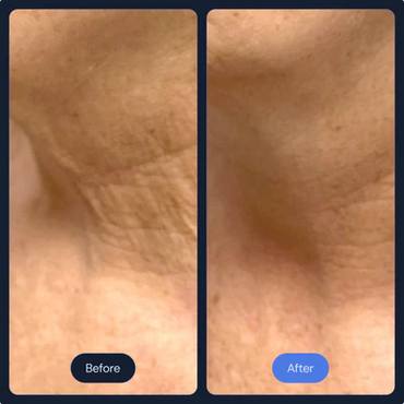 Before and After Frotox/Facials