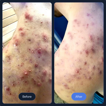 Localized Cryotherapy for scar, arthritis, acne and other skin conditions