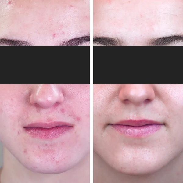 4- Disco Facials, 1- Peel, and 3- home care products her corrections healed in seven weeks' time.