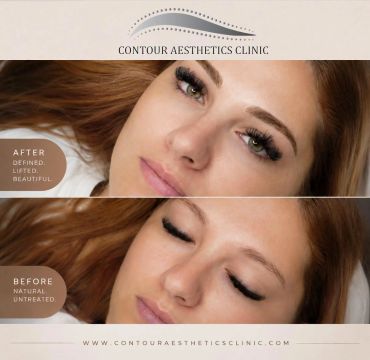 Before and after eyelash treatment at Contour Aesthetics Clinic.
