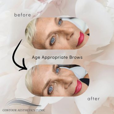 Before and after image of age-appropriate eyebrow enhancement.
