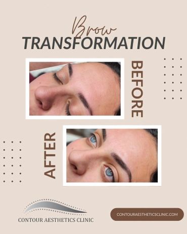 Brow transformation before and after treatment at Contour Aesthetics Clinic.