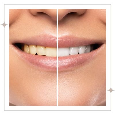 teeth whitening transformation, teeth whitening, before and after beauty service, bright smile