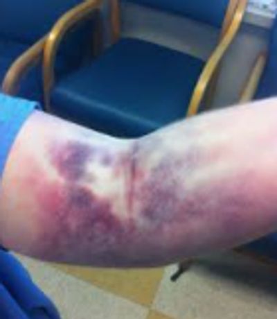 The bruising and painful consequences of bad venipuncture: blood draw, IV, injection of contrast, bl