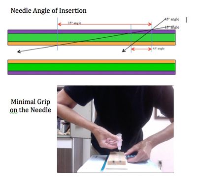 MATH dictates the 45 degree needle angle of entry to reduce vein wall damage and discomfort.