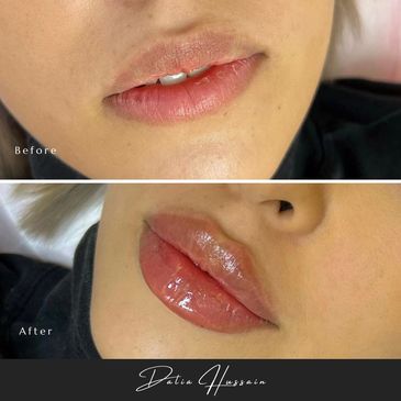 Russian Lip Filler, Russian Lip Fillers, Russian Lip Filler Kingston, Russian Lip Filler technique
